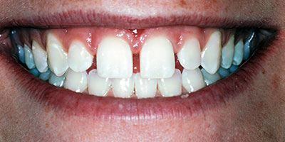 case-25-before-400x200