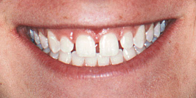 case-26-before-400x200