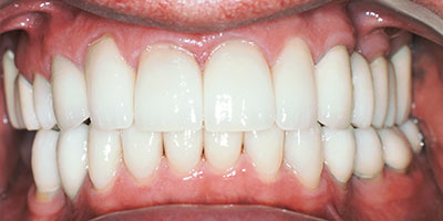 case-27-after-400x200