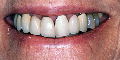 case-3-before-400x200
