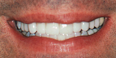 case-30-after-400x200