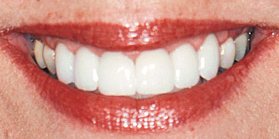 case-32-after-400x200