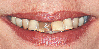 case-32-before-400x200