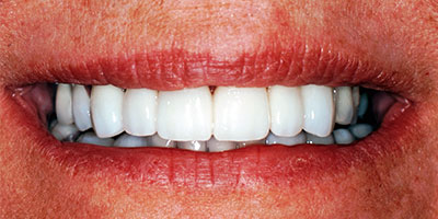case-33-after-400x200