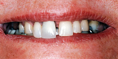 case-33-before-400x200