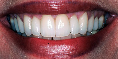 case-4-after-400x200