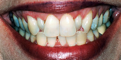 case-4-before-400x200