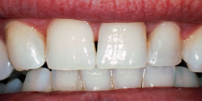 case-5-before-400x200
